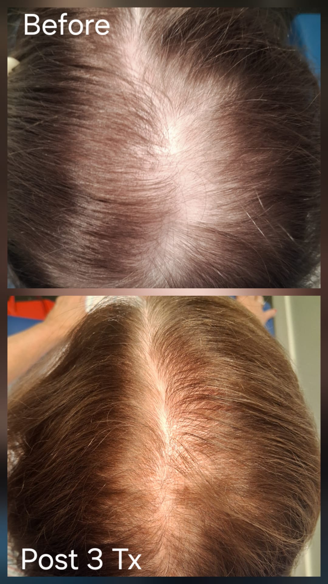 Hair restoration result